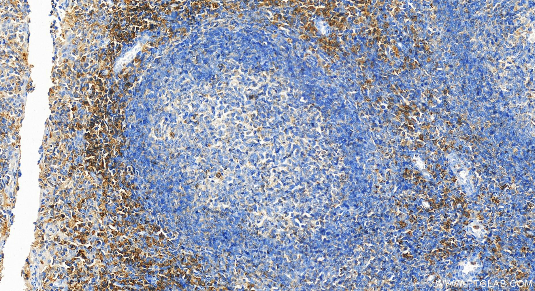 IHC staining of human tonsillitis using 24891-1-AP