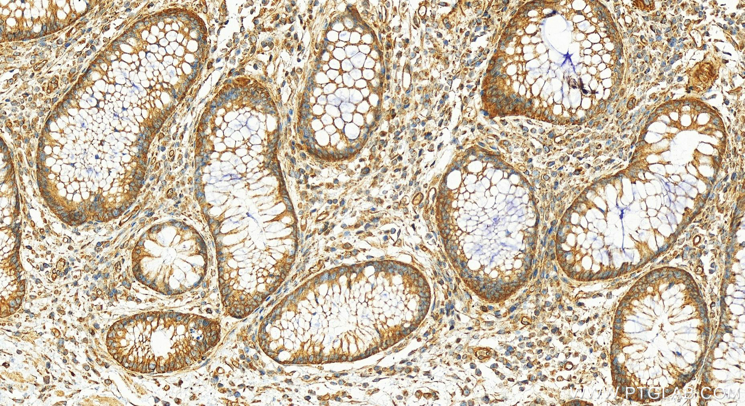 IHC staining of human colon cancer using 11913-1-AP