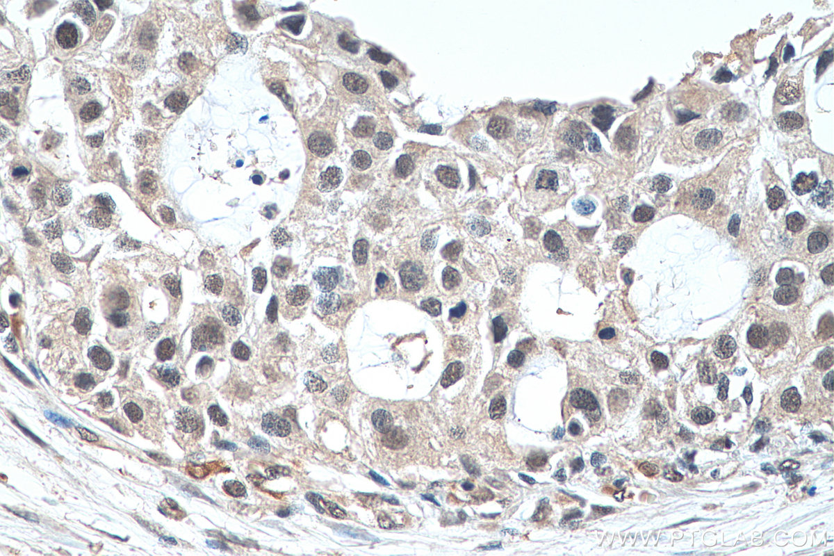 IHC staining of human breast cancer using 67636-1-Ig (same clone as 67636-1-PBS)