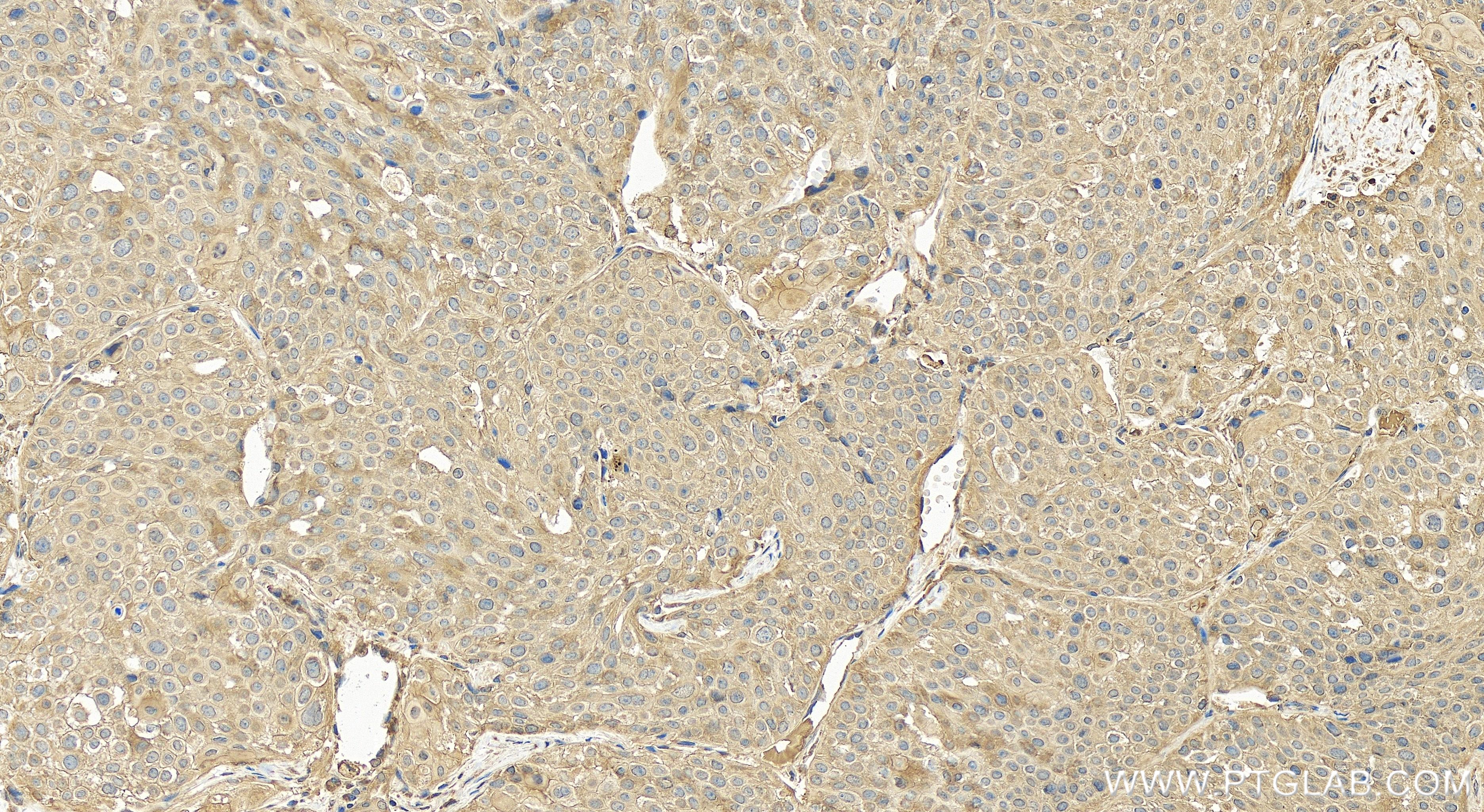 IHC staining of human lung cancer using 84966-2-RR