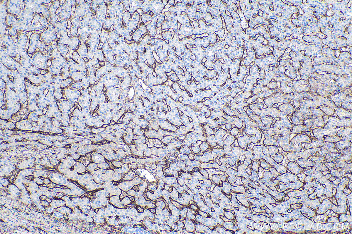 IHC staining of human liver cancer using 67075-1-Ig