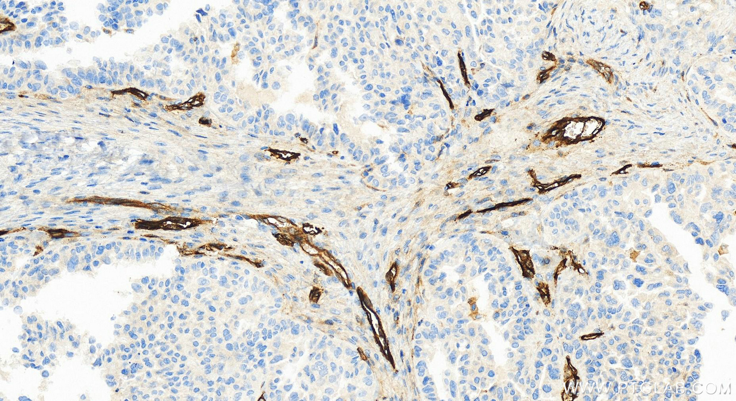 IHC staining of human ovary cancer using 82993-6-RR (same clone as 82993-6-PBS)