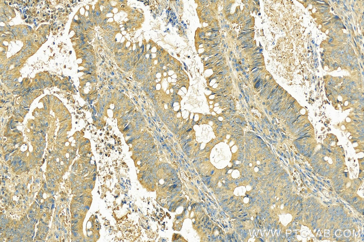 IHC staining of human colon cancer using 21252-1-AP