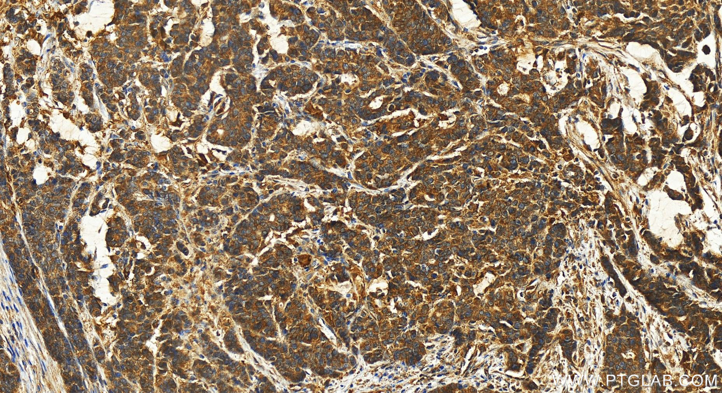 IHC staining of human stomach cancer using 21252-1-AP