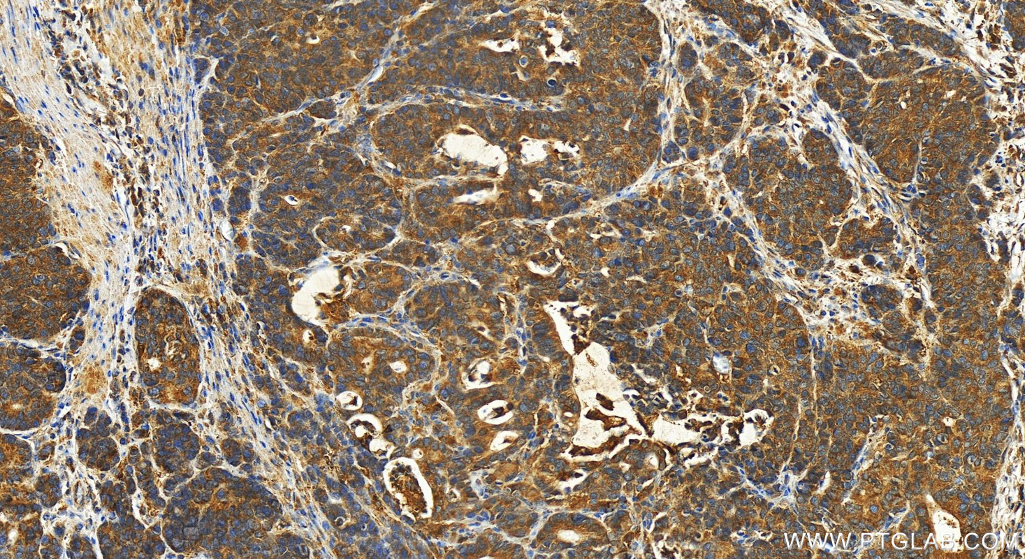 IHC staining of human stomach cancer using 21252-1-AP