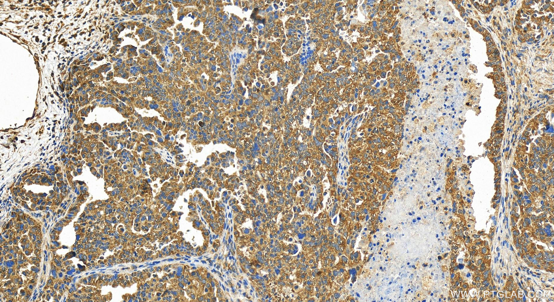 IHC staining of human ovary cancer using 15205-1-AP