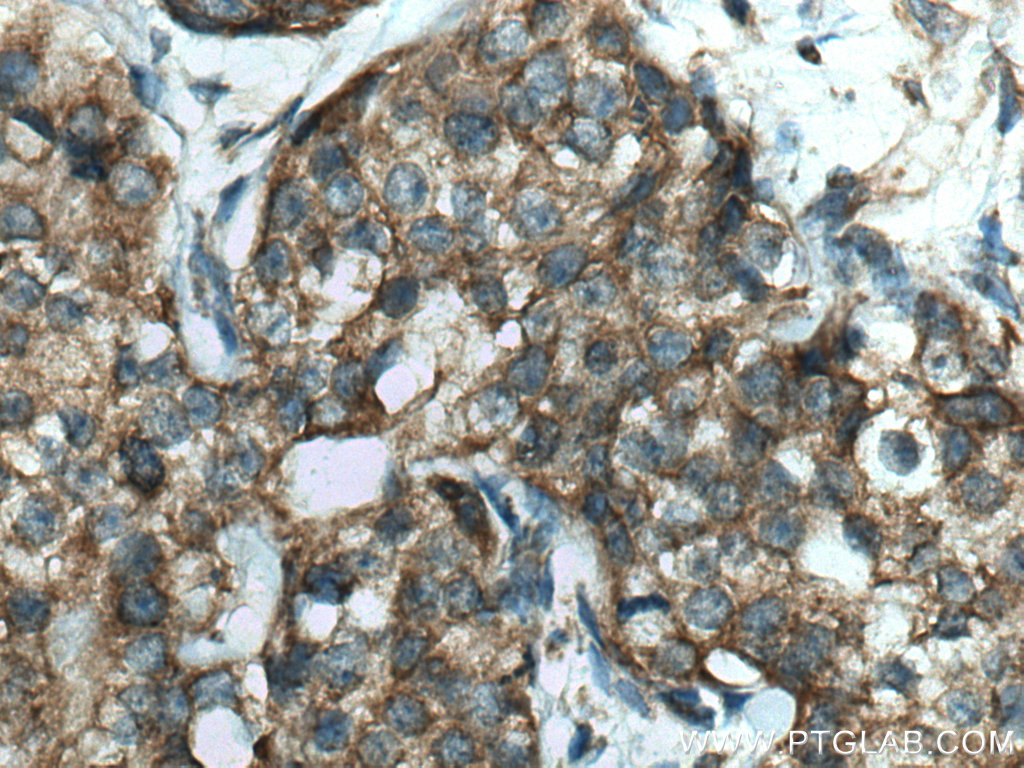 IHC staining of human breast cancer using 16251-1-AP