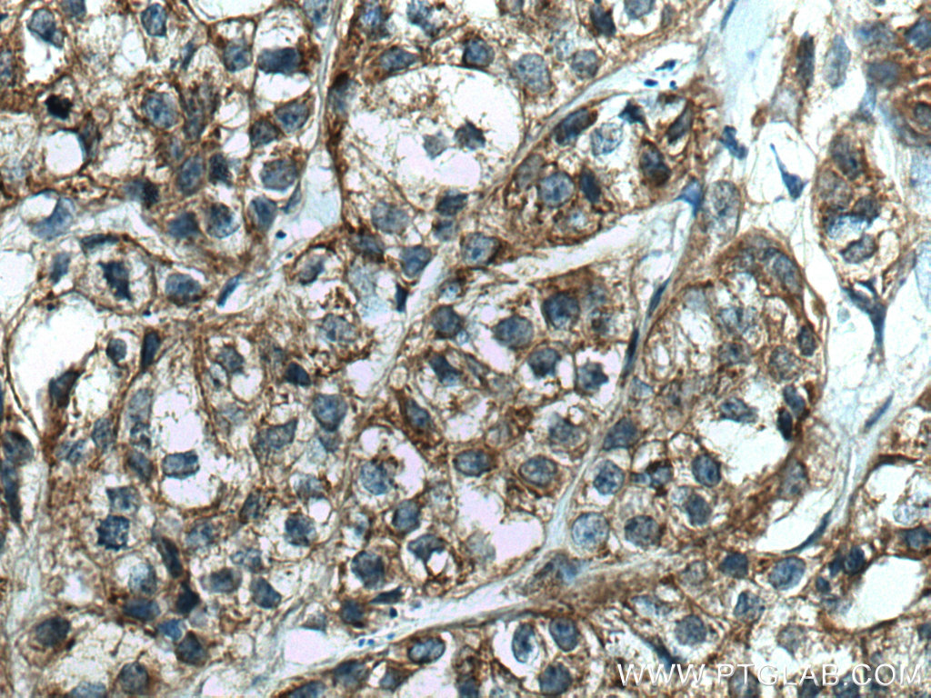 IHC staining of human breast cancer using 66629-1-Ig (same clone as 66629-1-PBS)