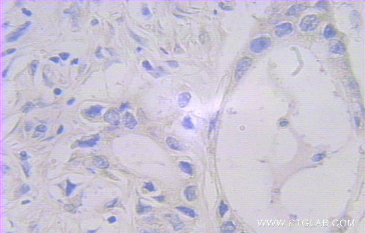 IHC staining of human pancreas cancer using 10307-1-AP