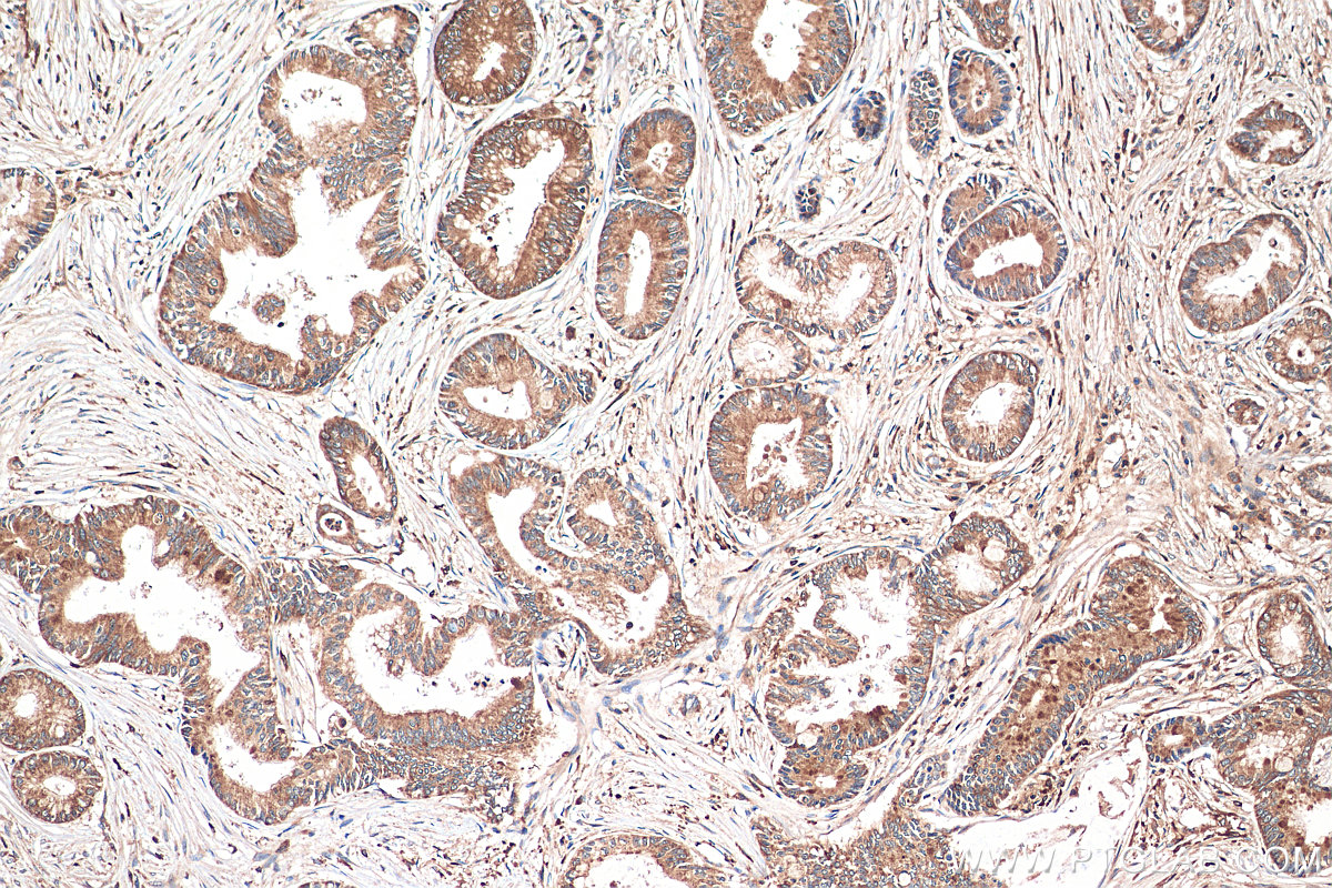 IHC staining of human pancreas cancer using 21333-1-AP