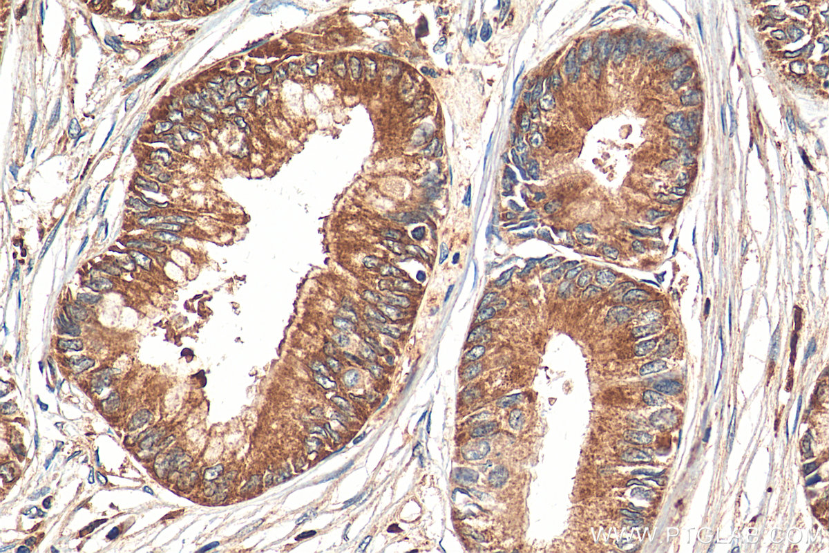 IHC staining of human pancreas cancer using 21333-1-AP