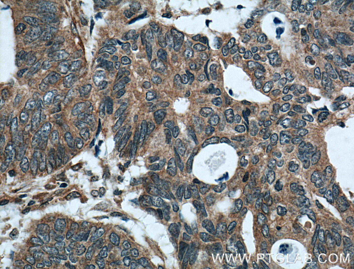 IHC staining of human colon cancer using 24929-1-AP