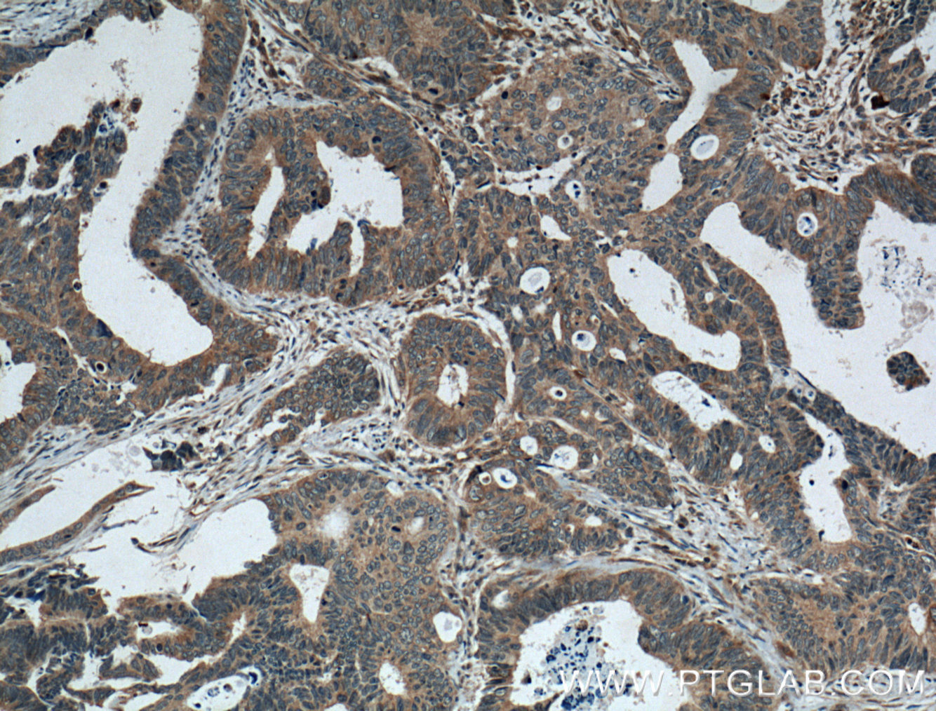 IHC staining of human colon cancer using 24929-1-AP