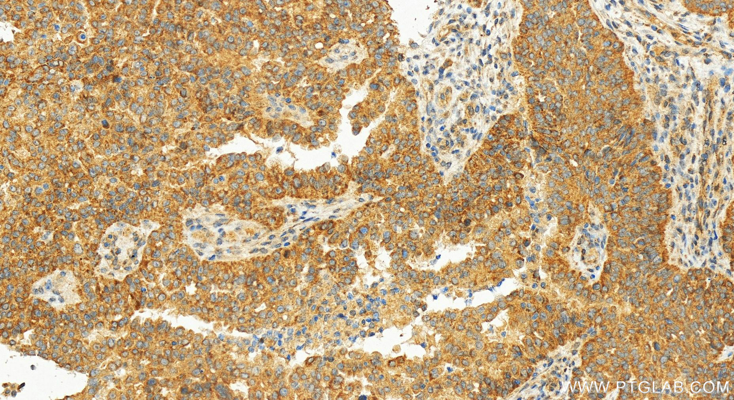 IHC staining of human ovarian  cancer using 83921-3-RR (same clone as 83921-3-PBS)