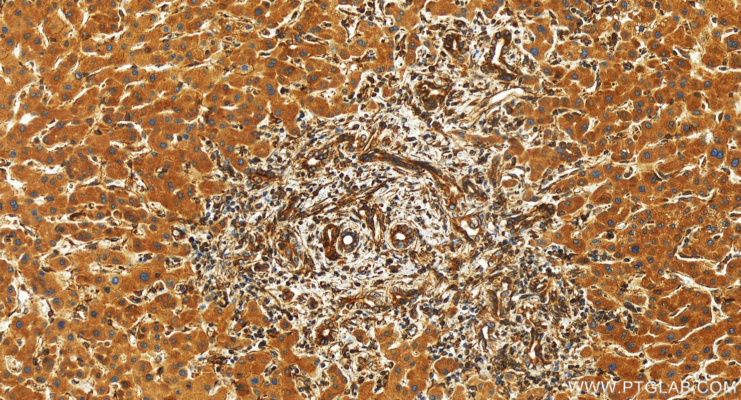 IHC staining of human intrahepatic cholangiocarcinoma using 24385-1-AP