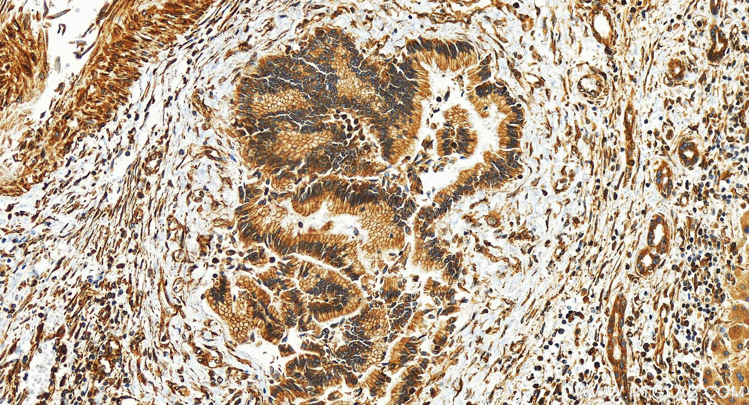 IHC staining of human intrahepatic cholangiocarcinoma using 24385-1-AP