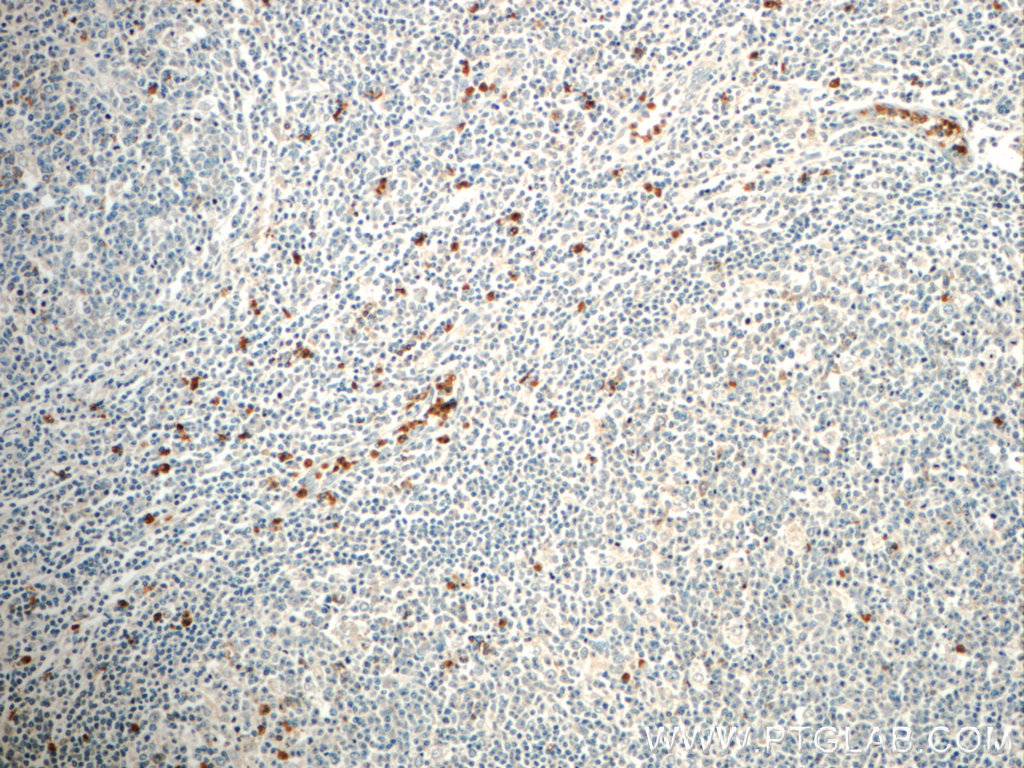 IHC staining of human tonsillitis using 21038-1-AP