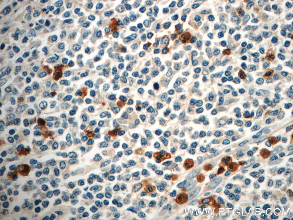 IHC staining of human tonsillitis using 21038-1-AP