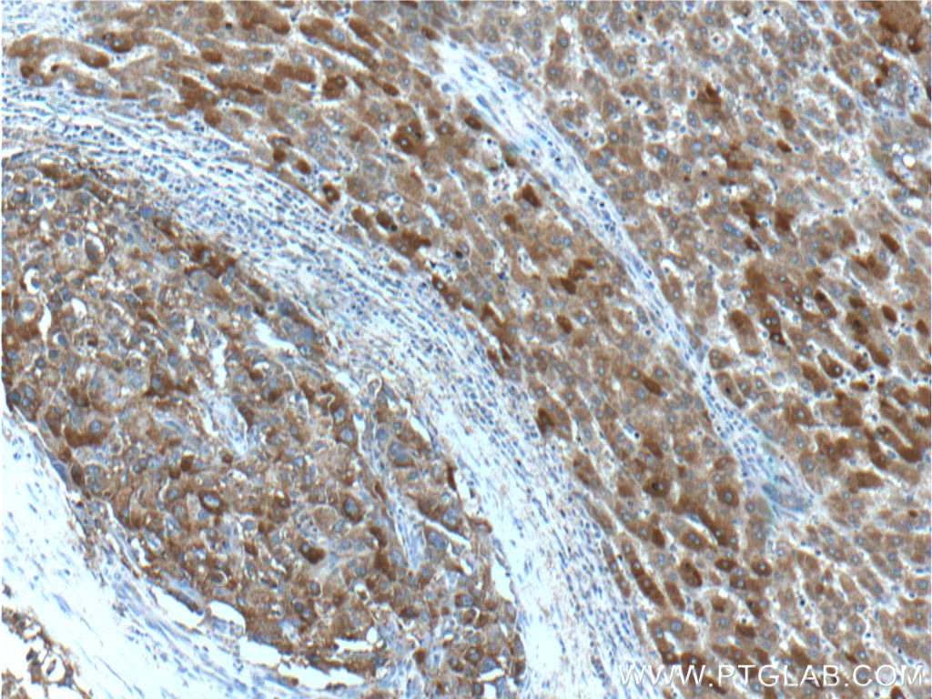 IHC staining of human liver cancer using 18421-1-AP