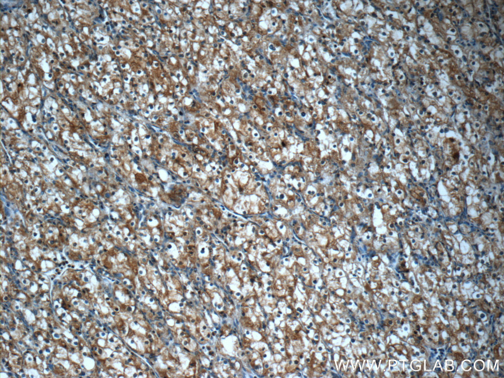 IHC staining of human renal cell carcinoma using 24803-1-AP