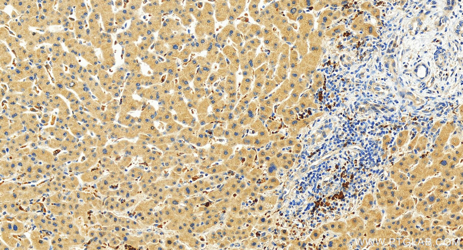 IHC staining of human intrahepatic cholangiocarcinoma using 20789-1-AP