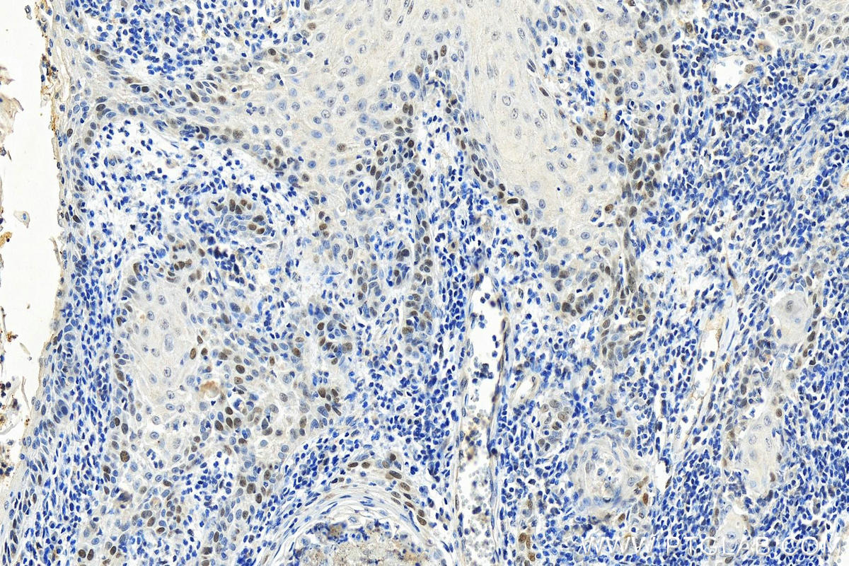 IHC staining of human skin cancer using 67304-1-Ig