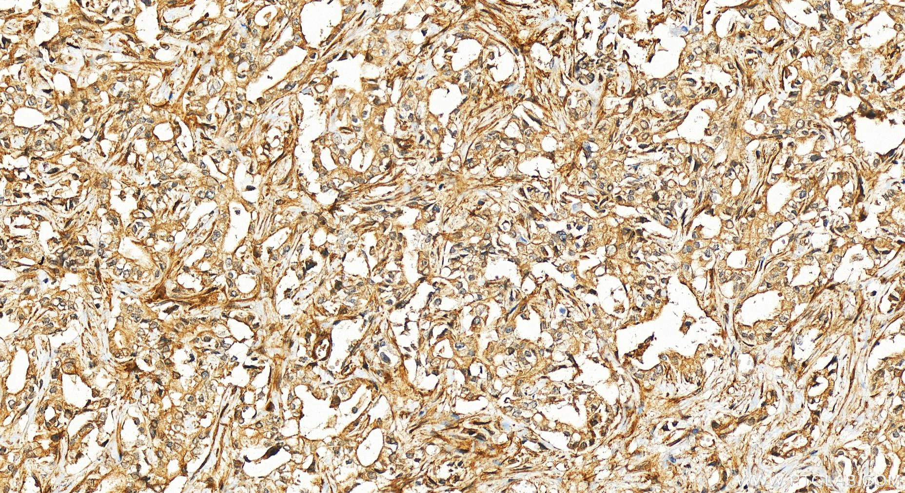 IHC staining of human intrahepatic cholangiocarcinoma using 11779-1-AP