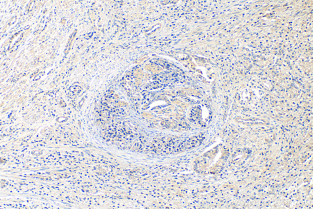 IHC staining of human prostate hyperplasia using 30733-1-AP