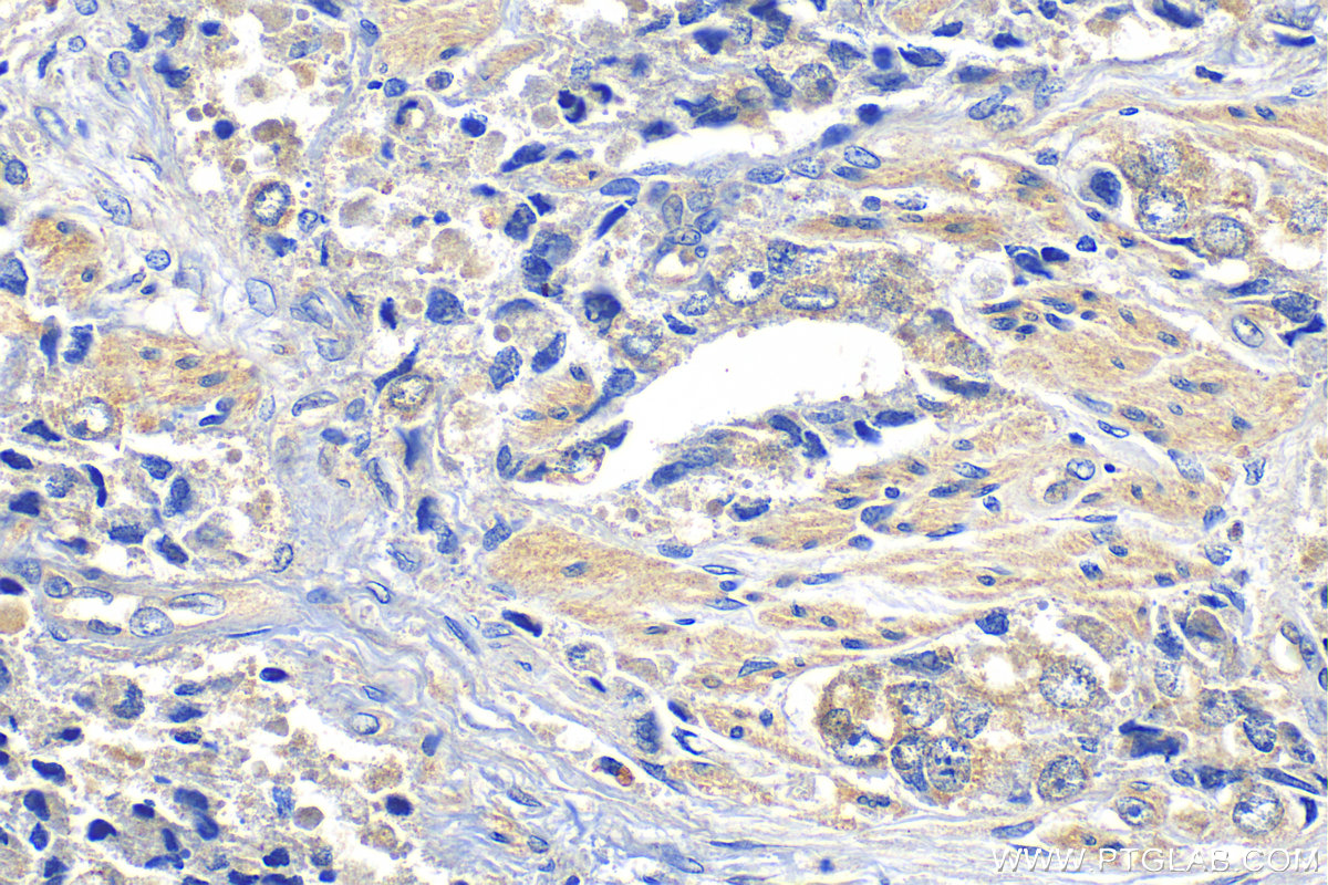 IHC staining of human prostate hyperplasia using 30733-1-AP