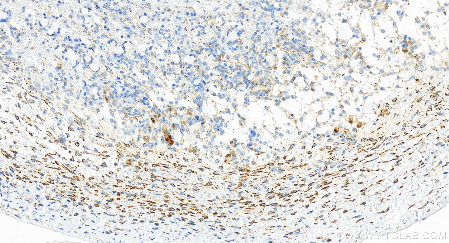 IHC staining of human ovary cancer using 83910-5-RR (same clone as 83910-5-PBS)