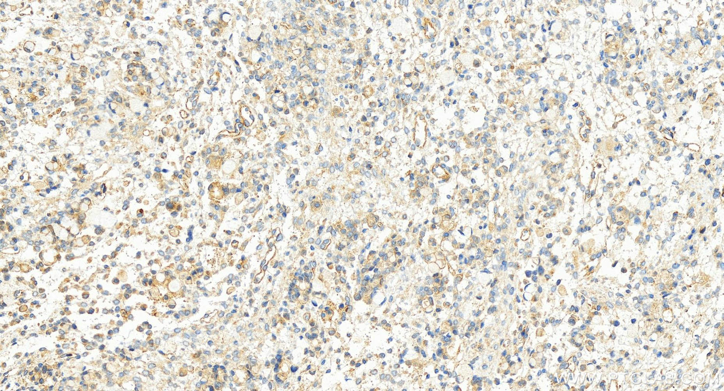 IHC staining of human ovary cancer using 13024-1-AP