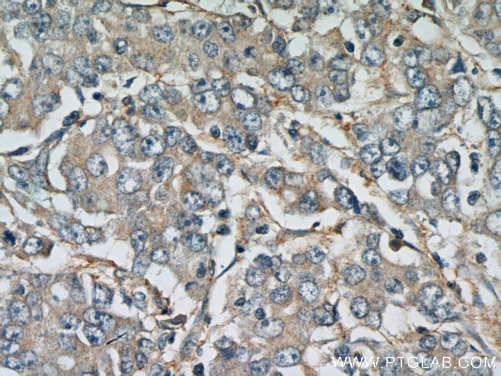 IHC staining of human stomach cancer using 13149-1-AP