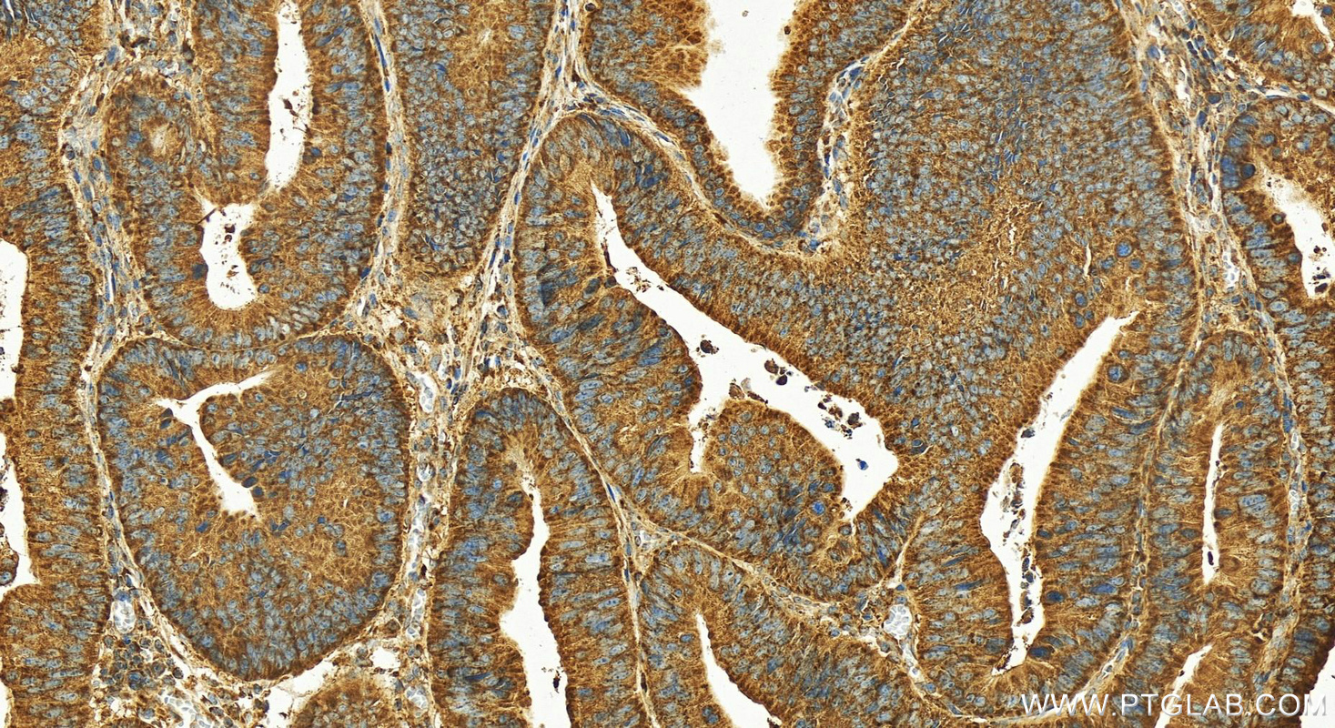 IHC staining of human colon cancer using 11499-1-AP