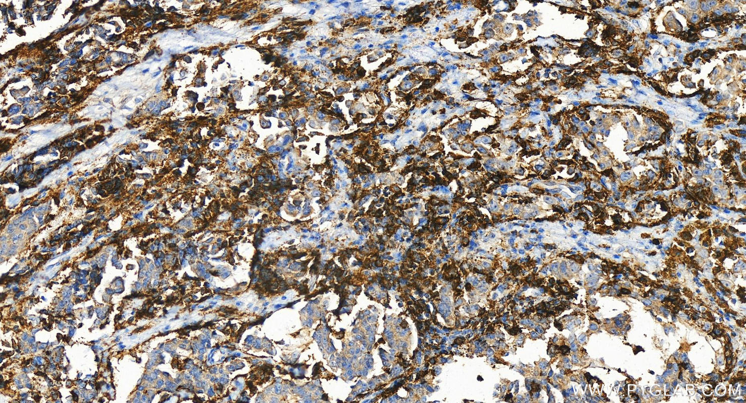 IHC staining of human ovary cancer using 13566-1-AP