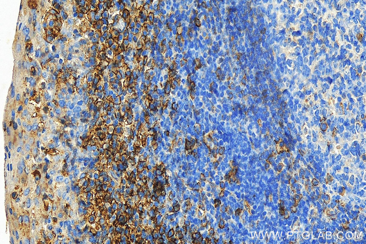 IHC staining of human tonsillitis using 21541-1-AP