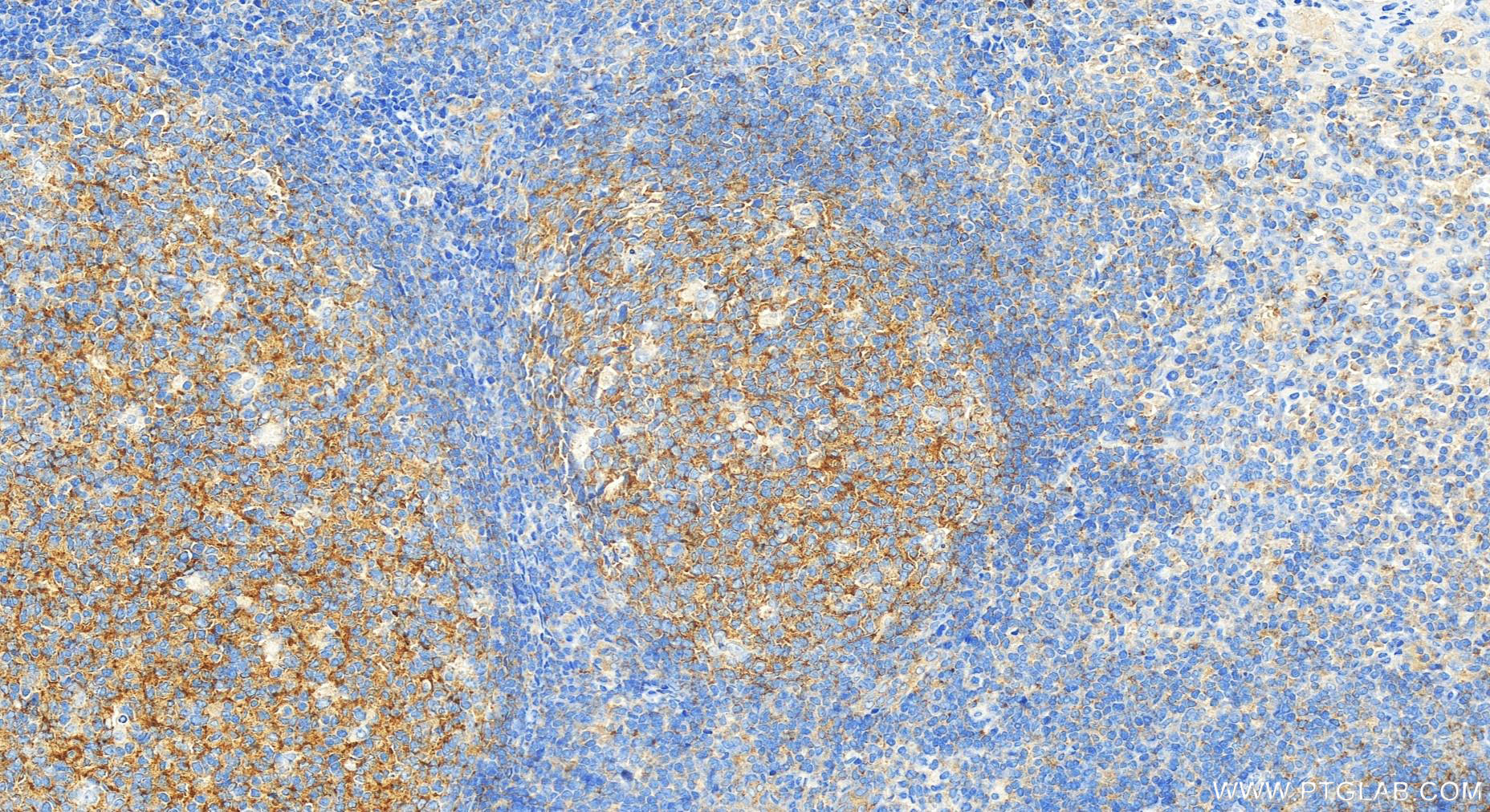 IHC staining of human tonsillitis using 26767-1-AP