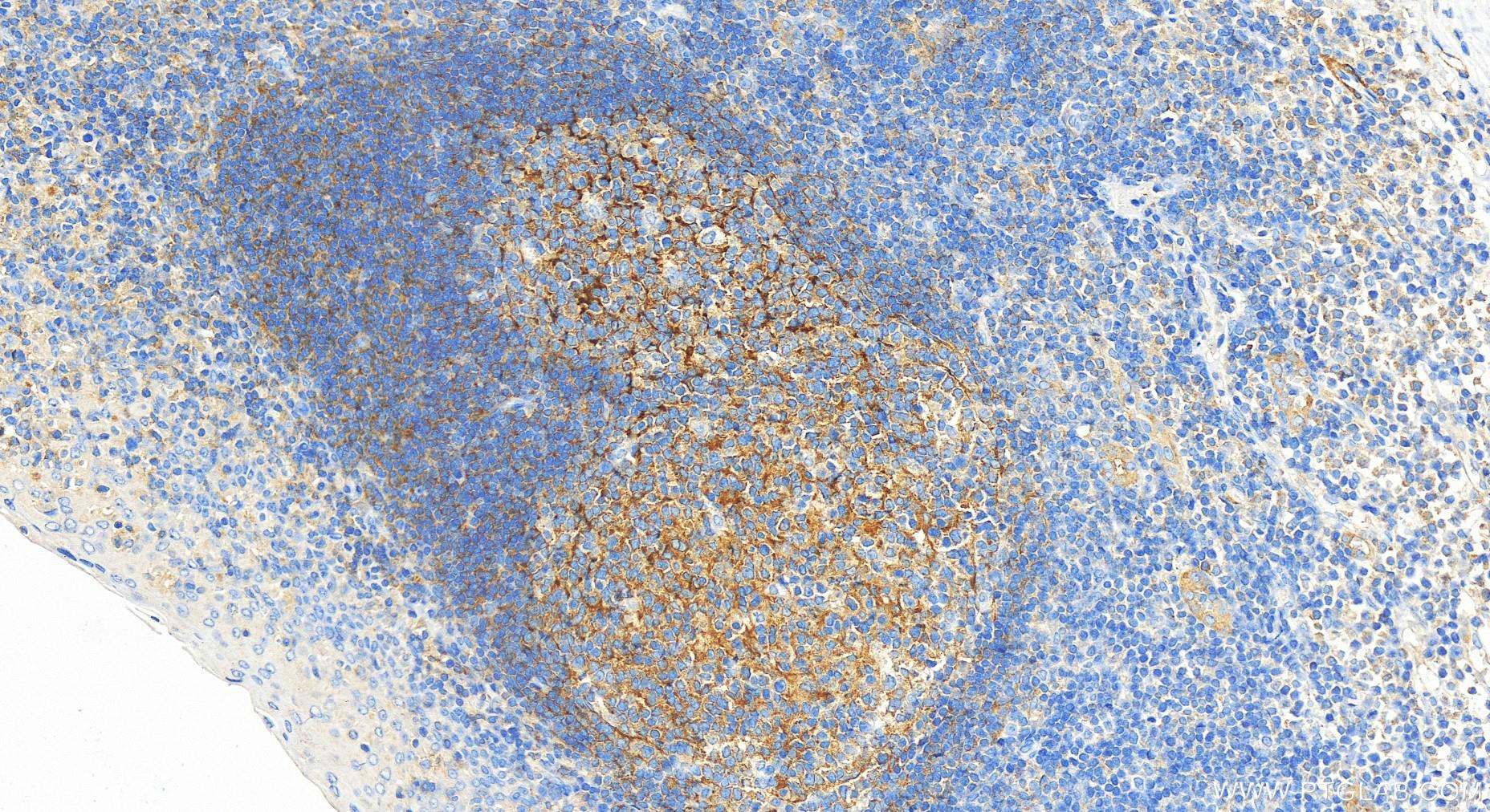 IHC staining of human tonsillitis using 26767-1-AP