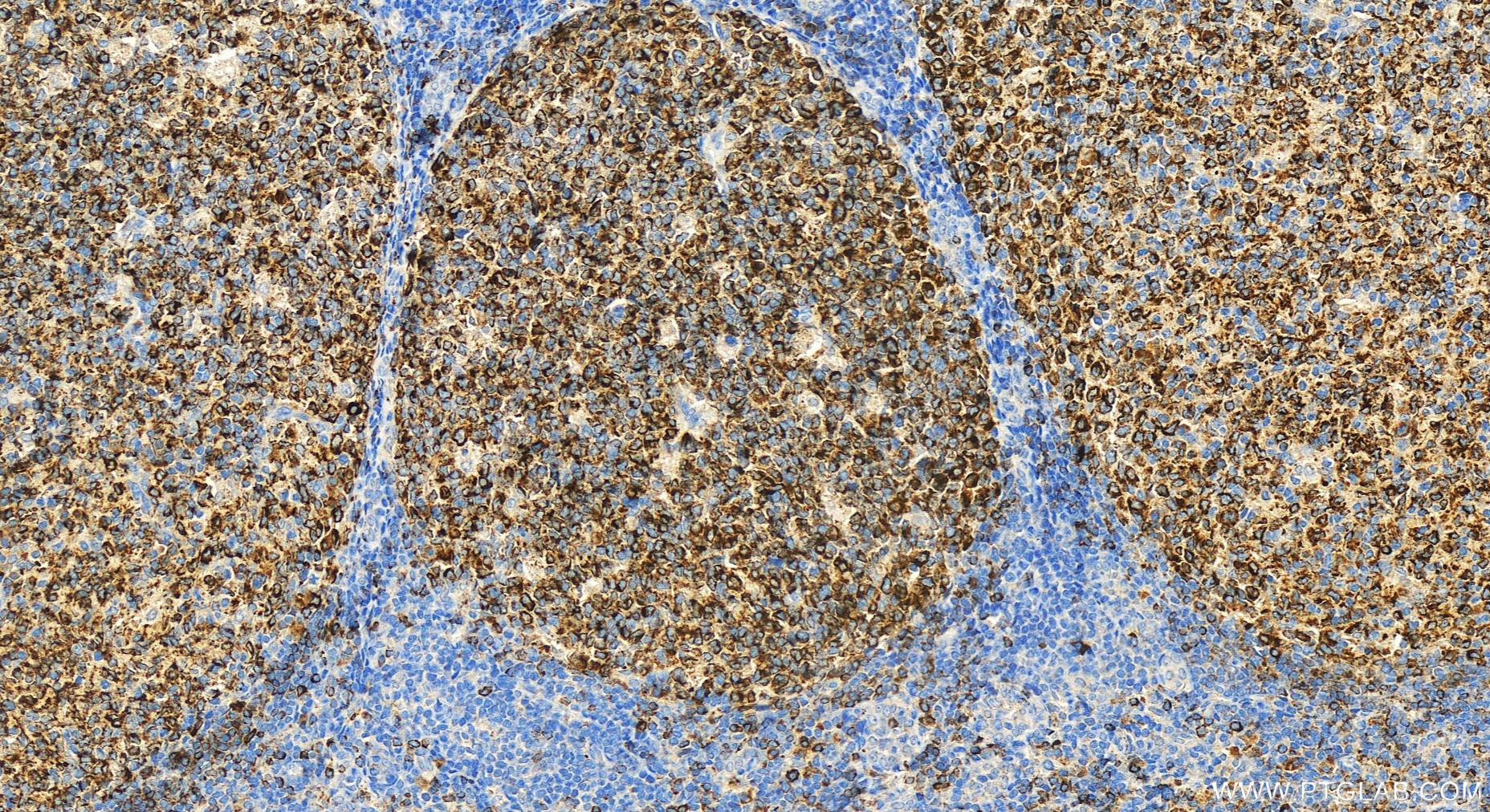 IHC staining of human tonsillitis using 26949-1-AP