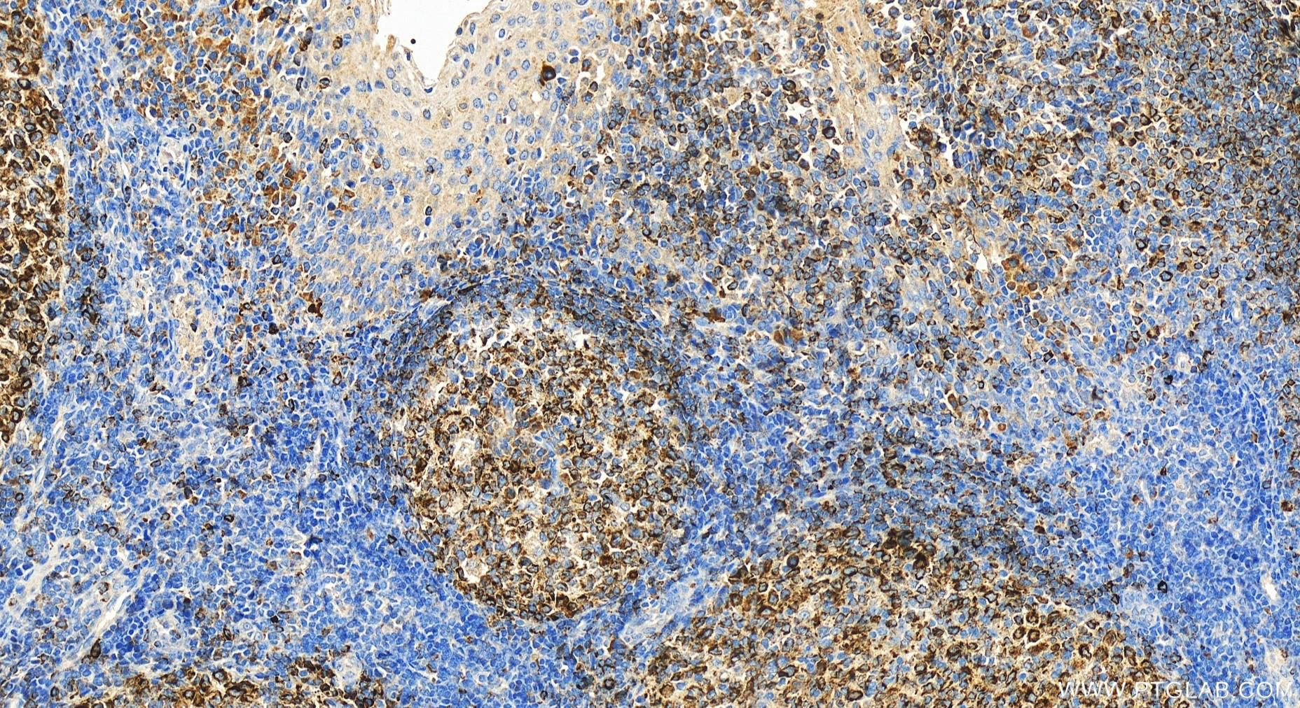 IHC staining of human tonsillitis using 26949-1-AP