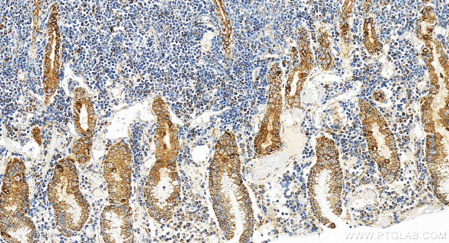 IHC staining of human stomach cancer using 82957-1-RR (same clone as 82957-1-PBS)