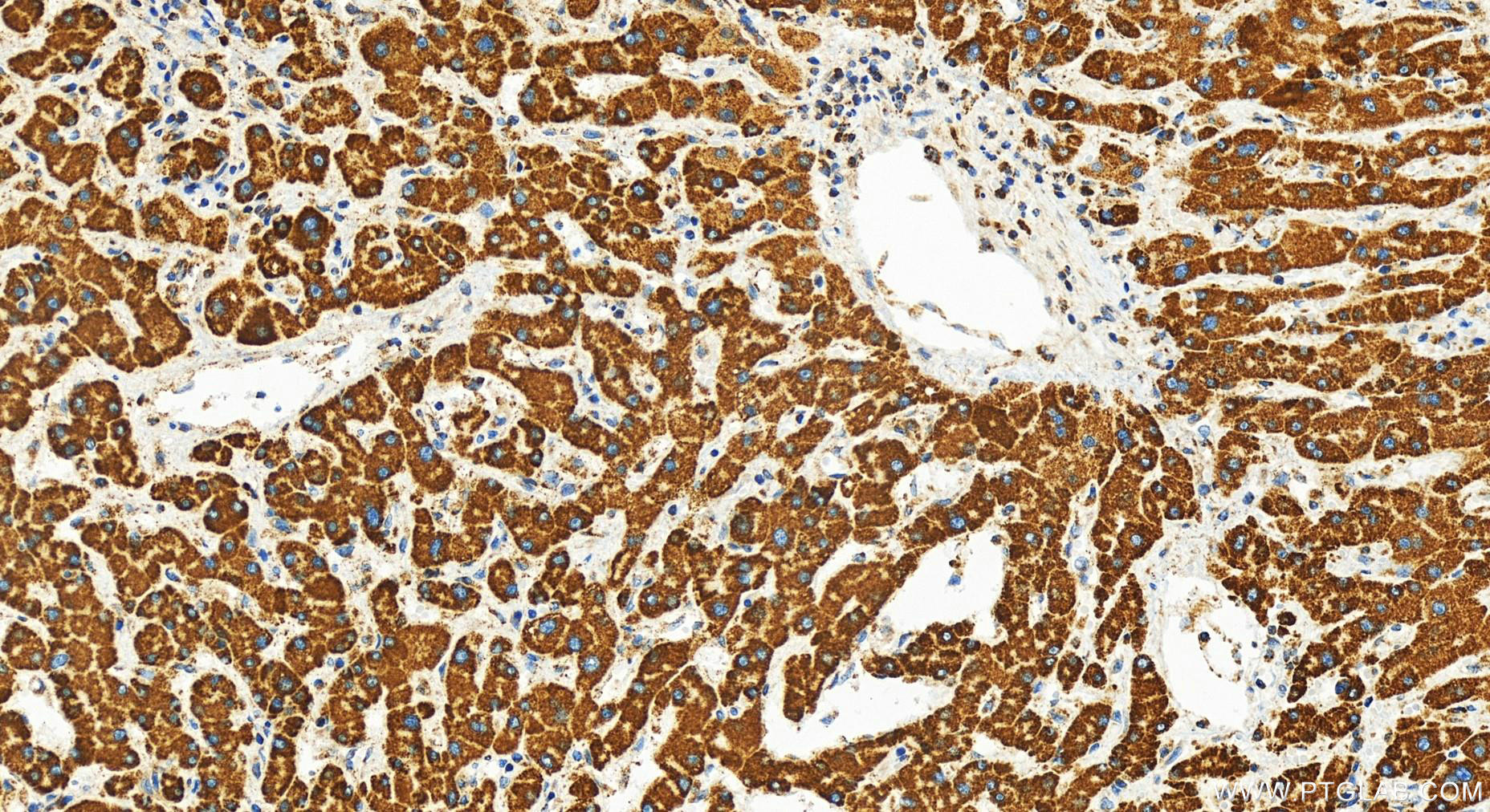 IHC staining of human intrahepatic cholangiocarcinoma using 82957-1-RR (same clone as 82957-1-PBS)