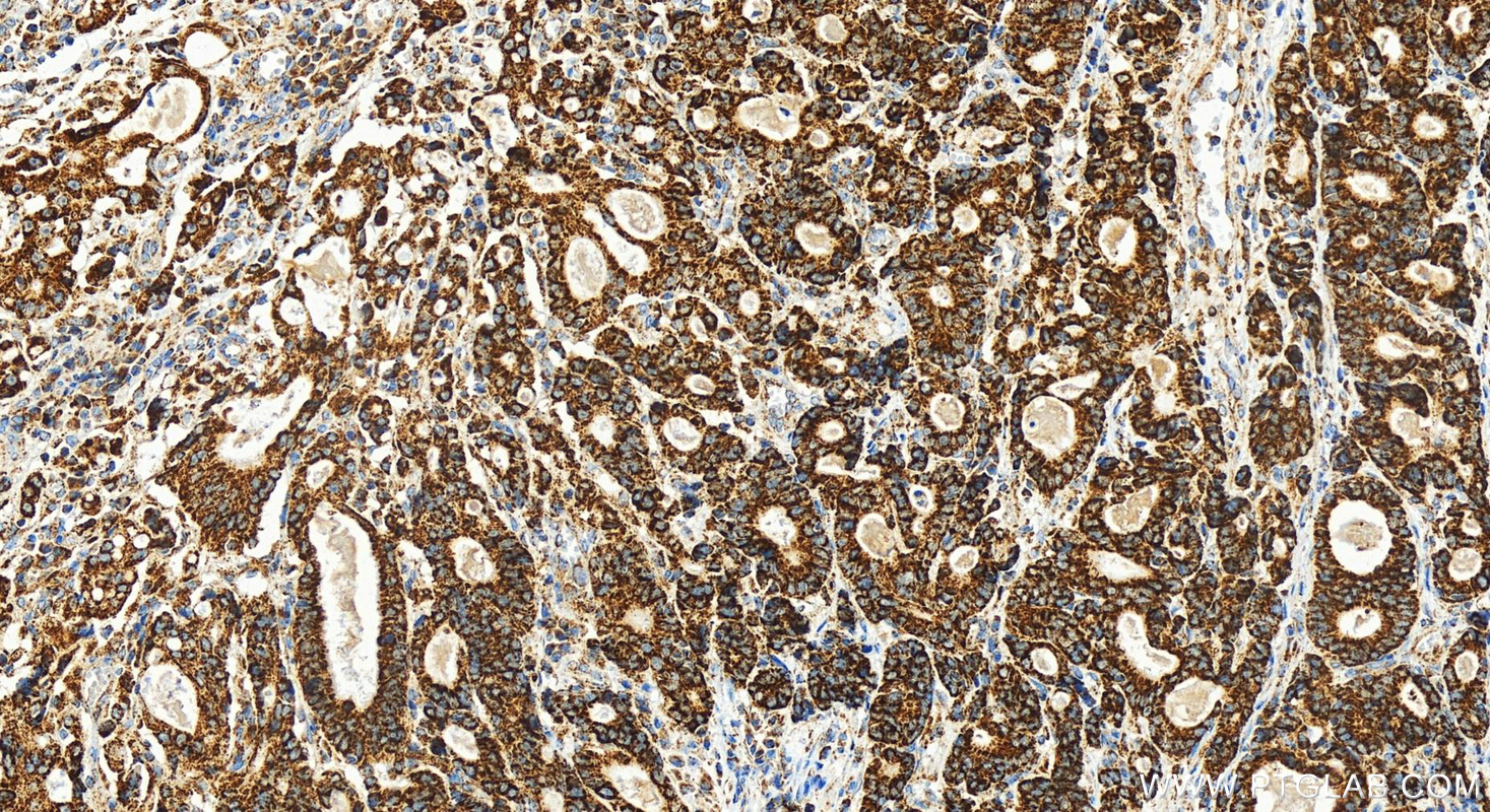 IHC staining of human stomach cancer using 82957-2-RR (same clone as 82957-2-PBS)