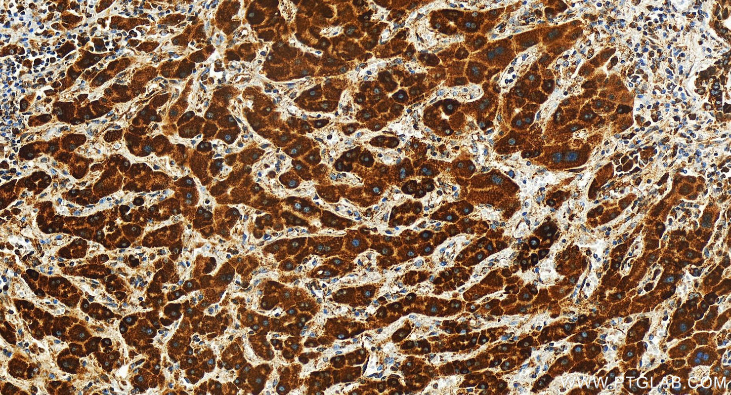 IHC staining of human intrahepatic cholangiocarcinoma using 82957-2-RR