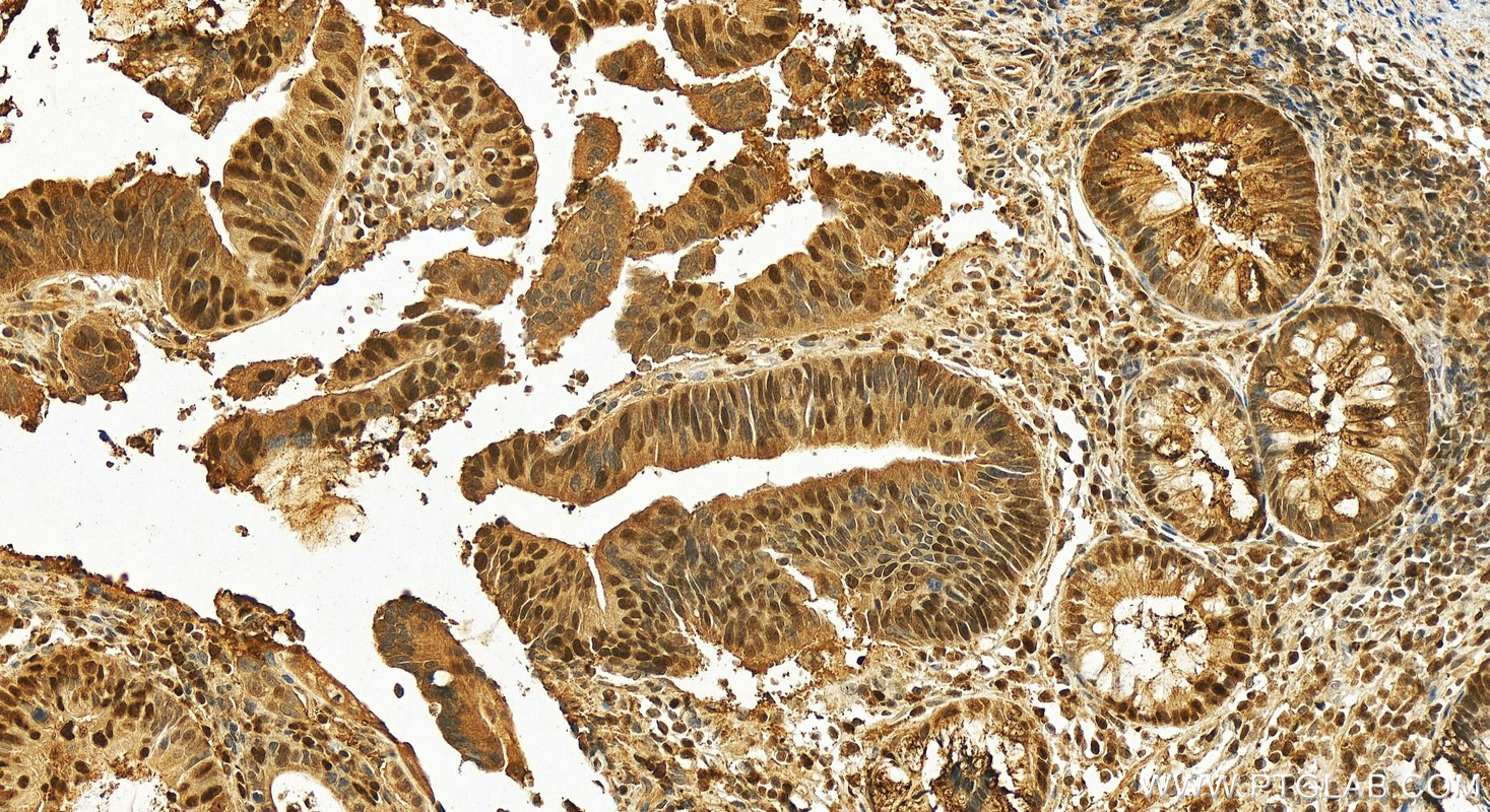 IHC staining of human colon cancer using 14768-1-AP