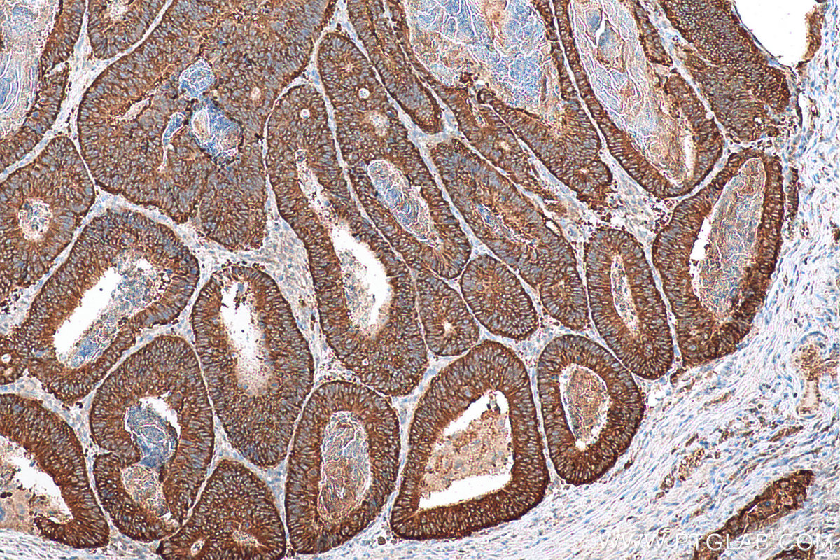 IHC staining of human colon cancer using 22215-1-AP