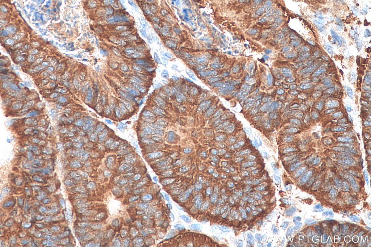 IHC staining of human colon cancer using 22215-1-AP