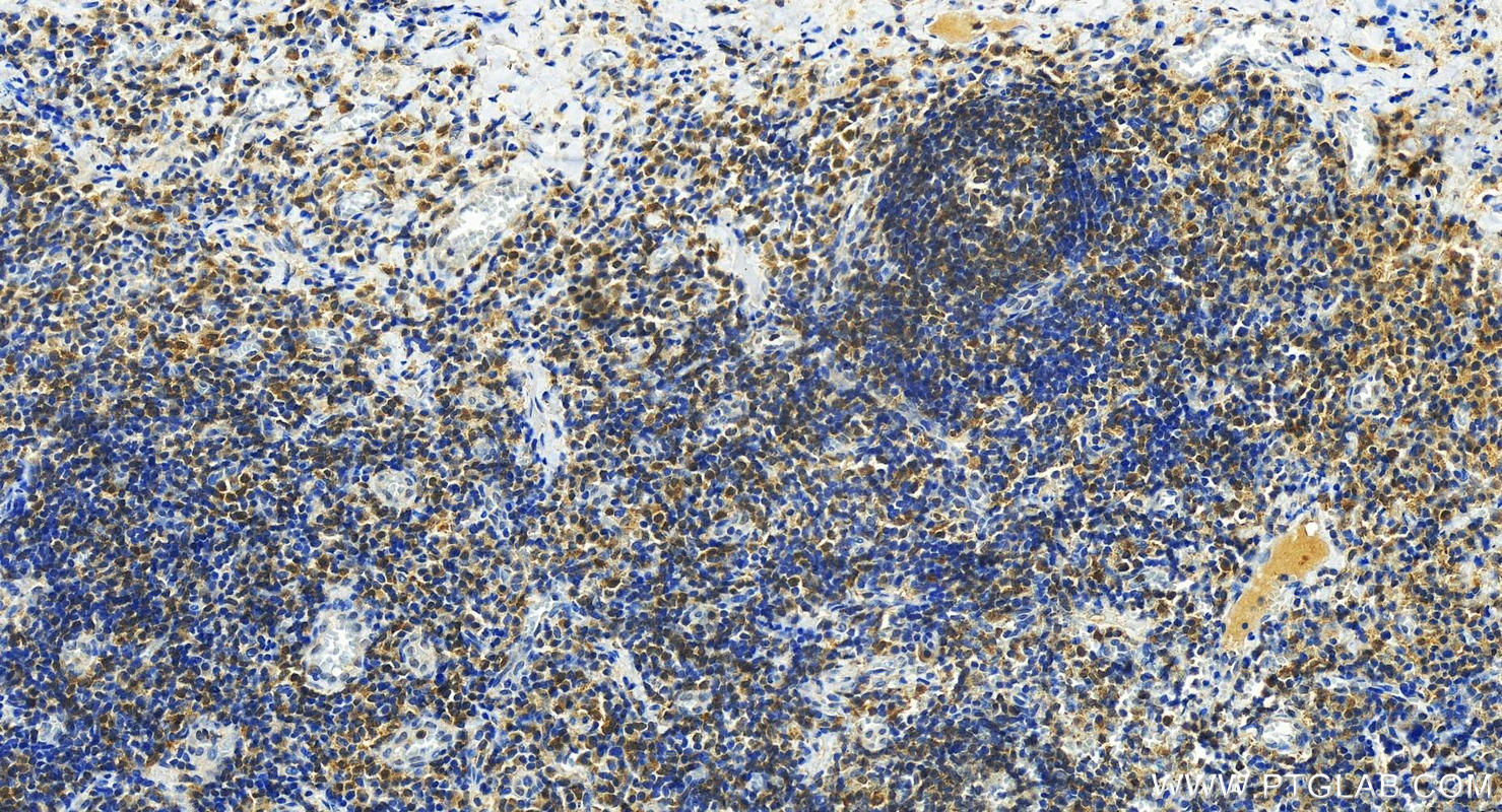 IHC staining of human tonsillitis using 27068-1-AP