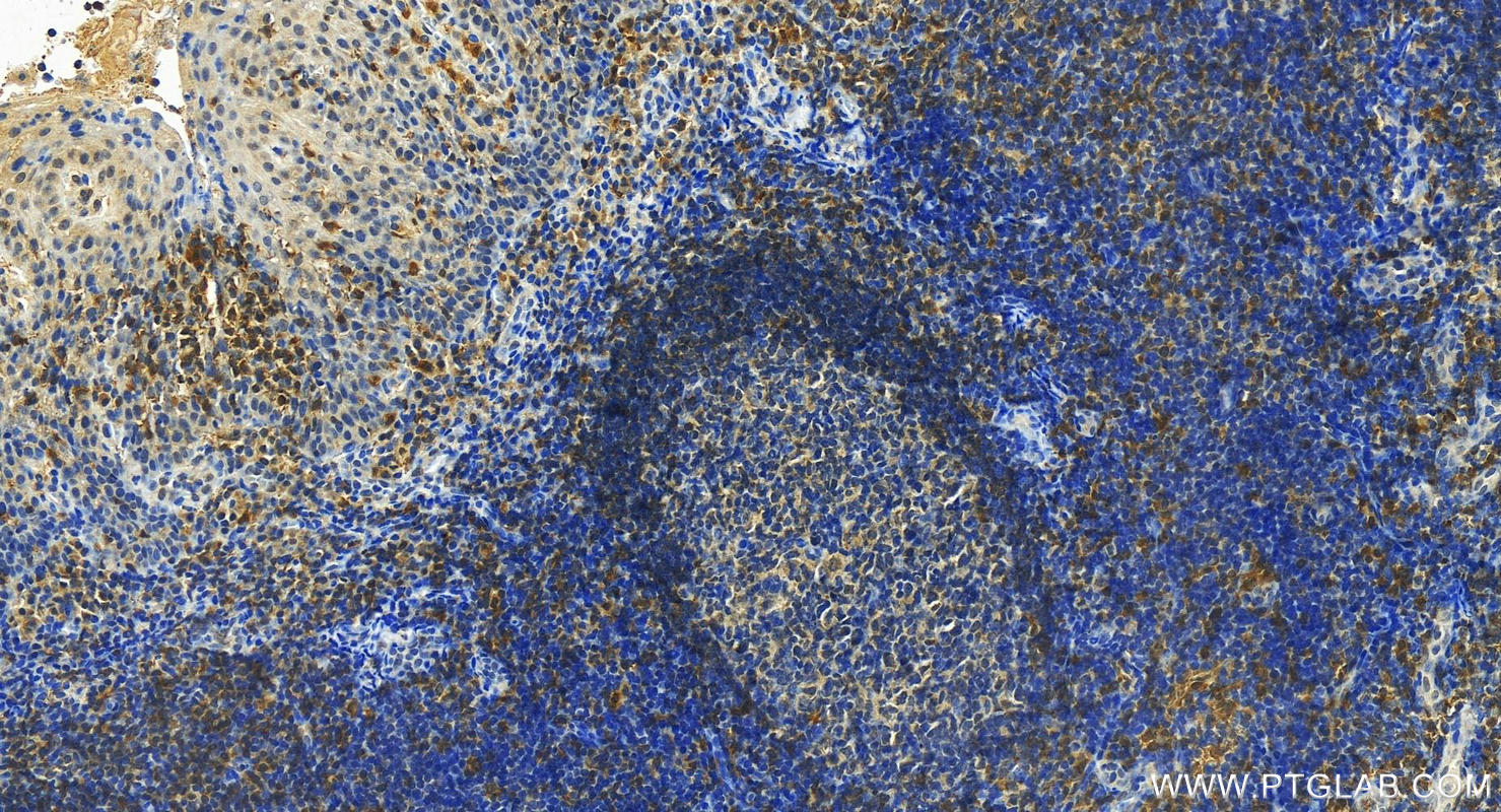 IHC staining of human tonsillitis using 27068-1-AP