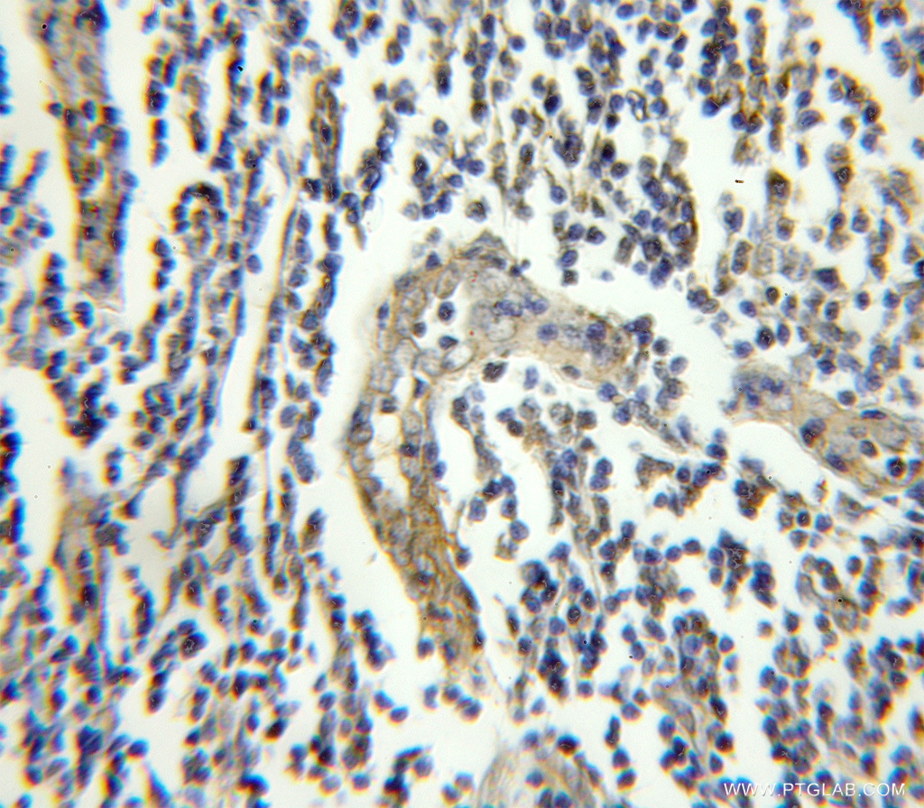 IHC staining of human lymphoma using 11343-1-AP (same clone as 11343-1-PBS)