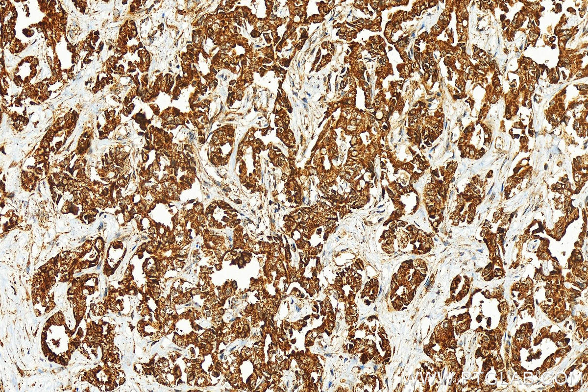 IHC staining of human intrahepatic cholangiocarcinoma using 11605-1-AP